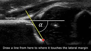 Correcting Hip Dysplasia with Ganz Osteotomy [upl. by Acacia]