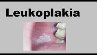 Leukoplakia [upl. by Eiclehc]